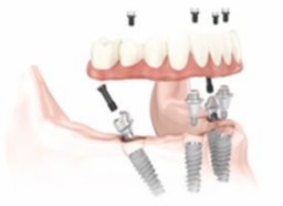 especialistas-en-implantes-dentales.jpg